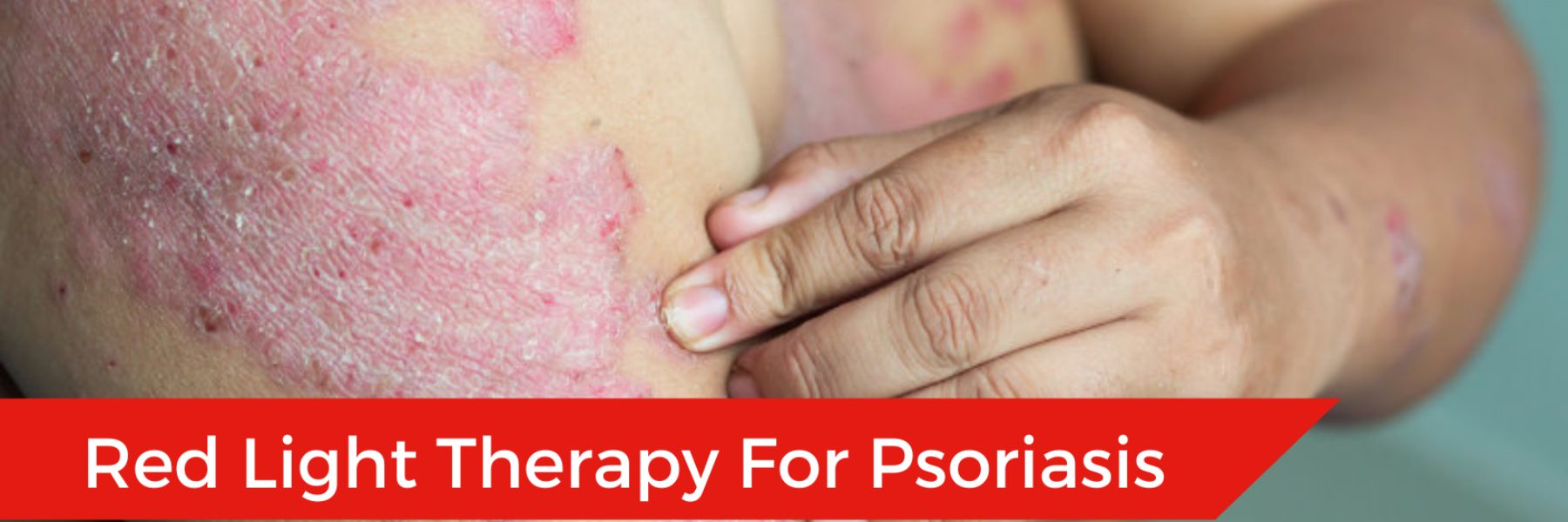 Close-up of psoriasis patches on skin, highlighting condition treated with red light therapy