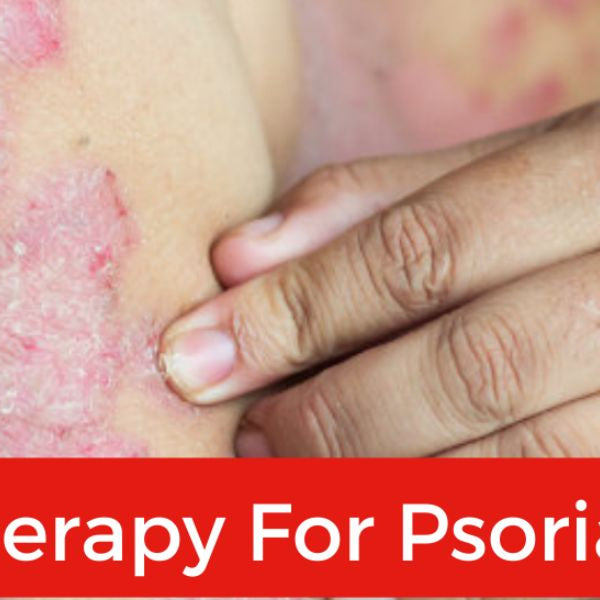 Close-up of psoriasis patches on skin, highlighting condition treated with red light therapy
