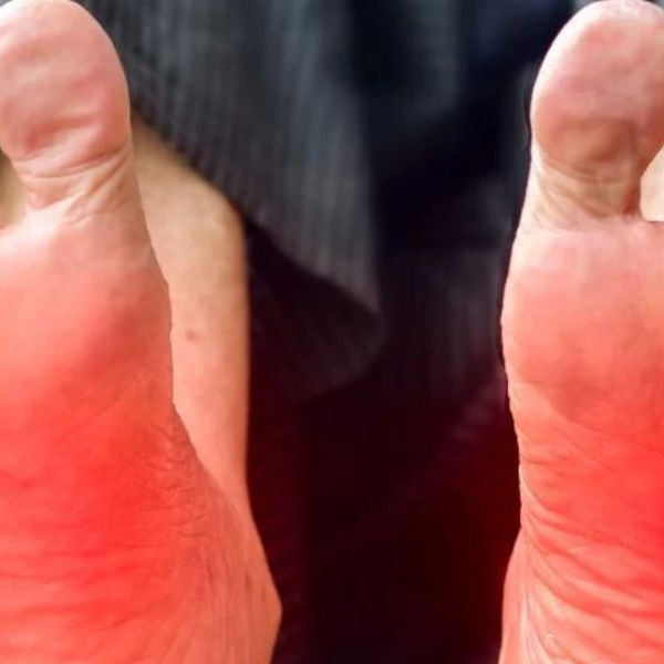 Close-up of inflamed feet showing nerve pain symptoms linked to neuropathy and poor circulation